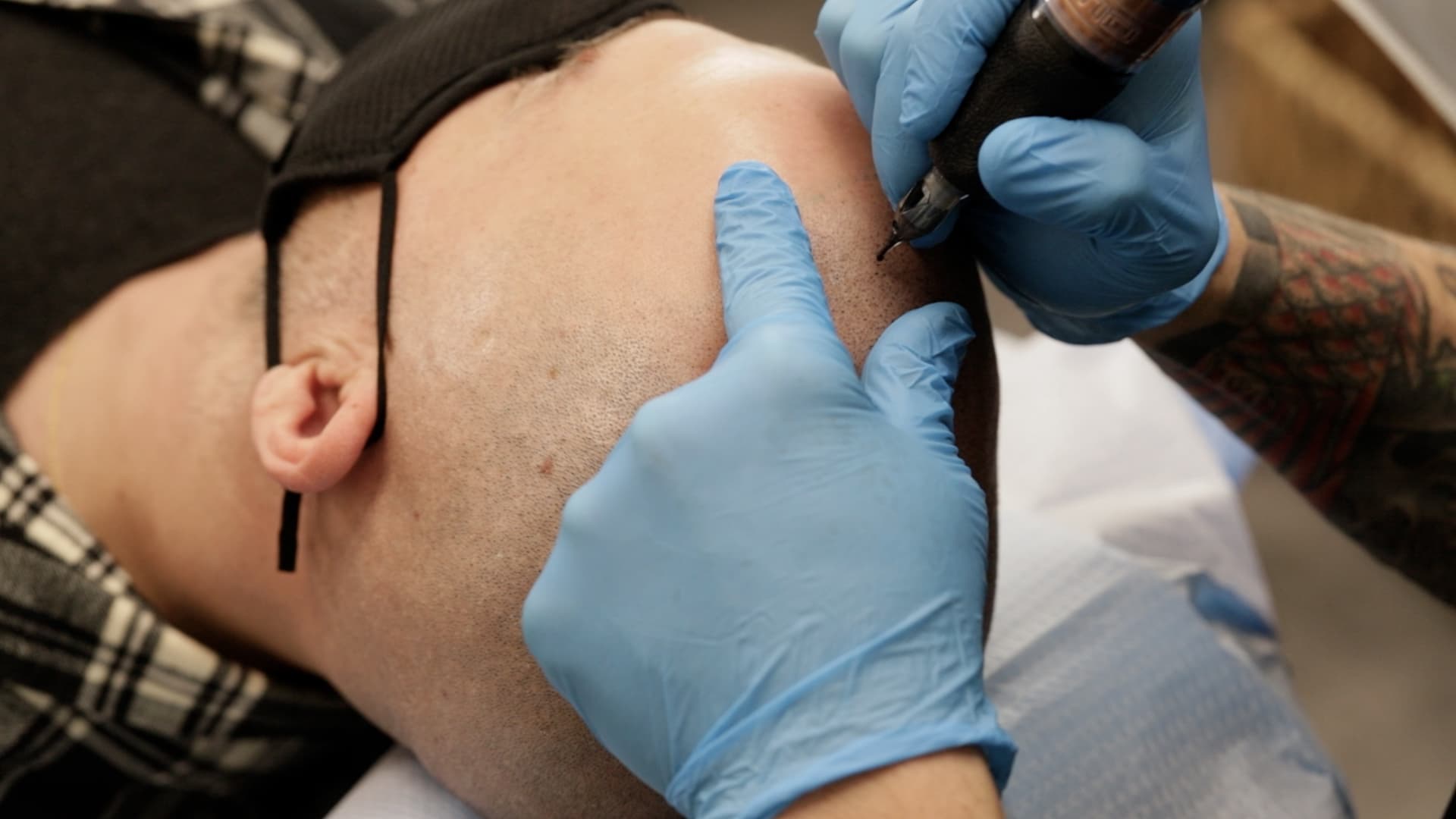 Scalp Micropigmentation in Vancouver and Langley