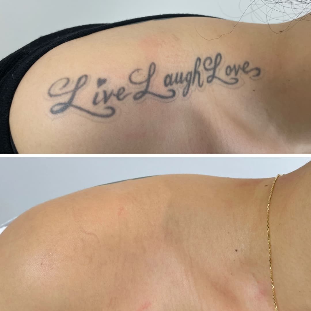 Studio Kiku pricing information for the Complete Tattoo Removal Package