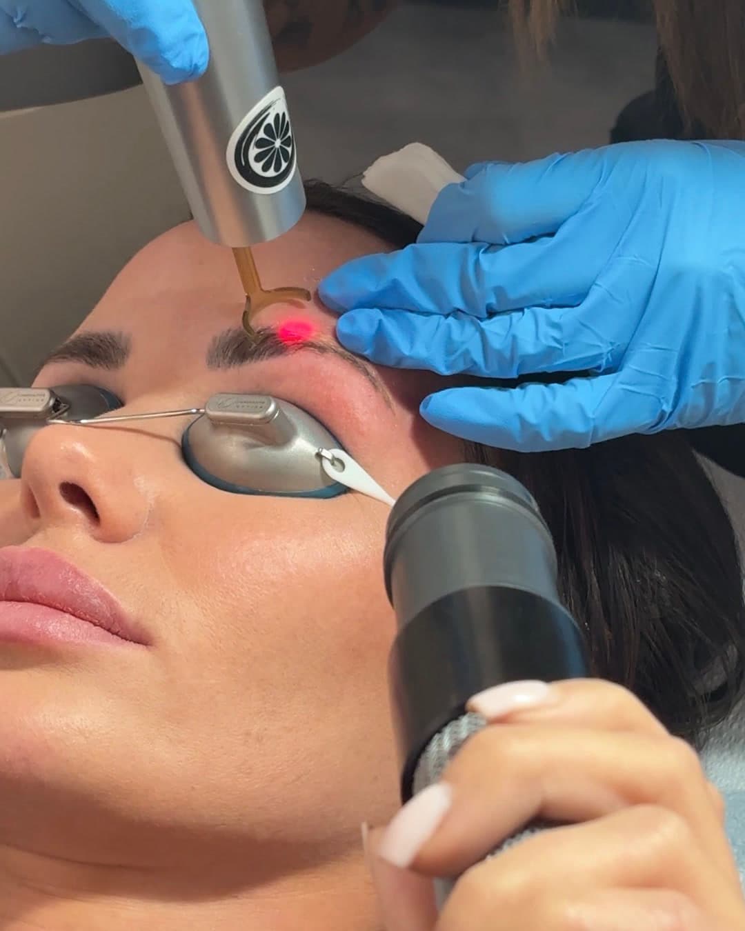 Close-up of a client's brow area before a PMU removal session at Studio Kiku.