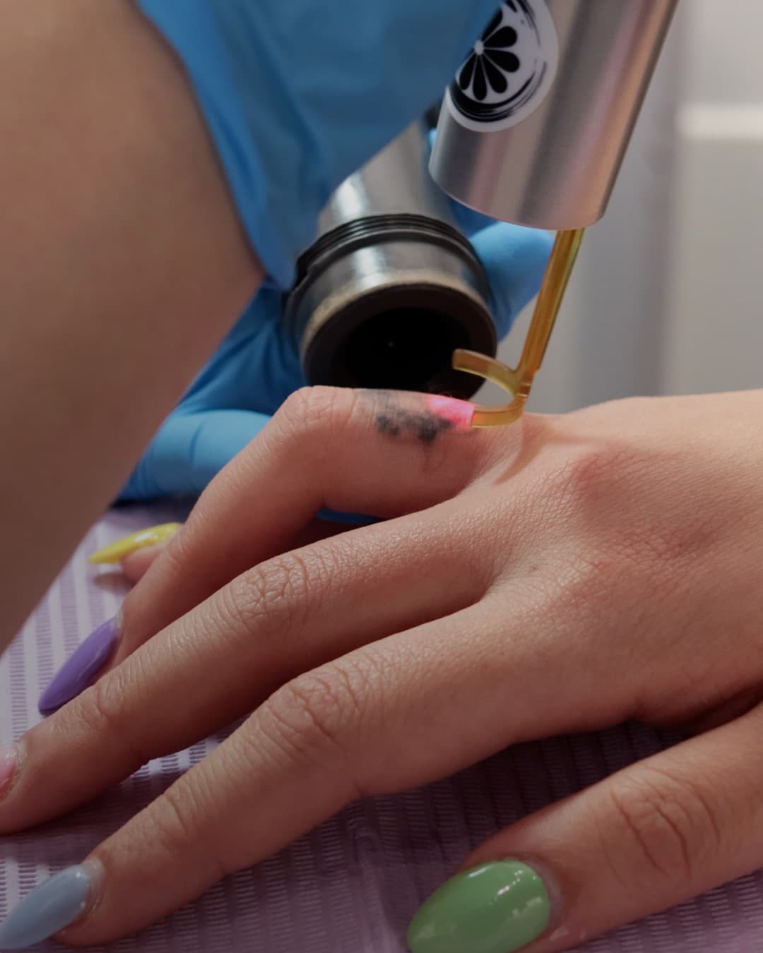 PicoWay laser tattoo removal in progress on a finger at Studio Kiku