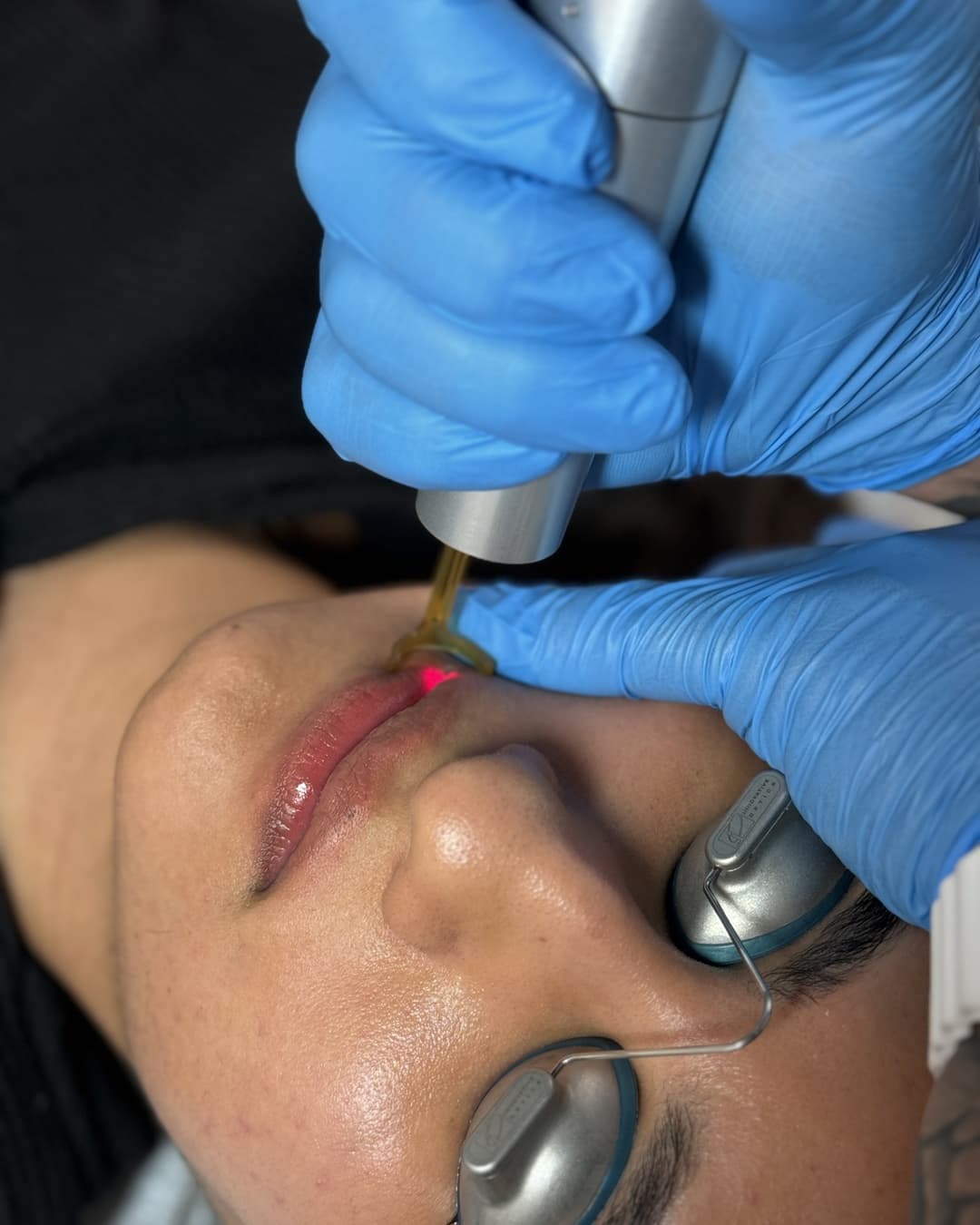Laser removal of lip blush pigment at Studio Kiku