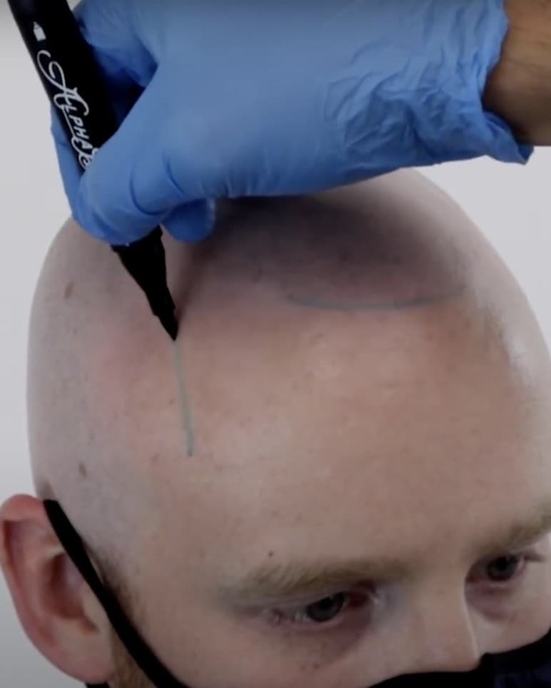 Drawing a new hairline before scalp micropigmentation at Studio Kiku