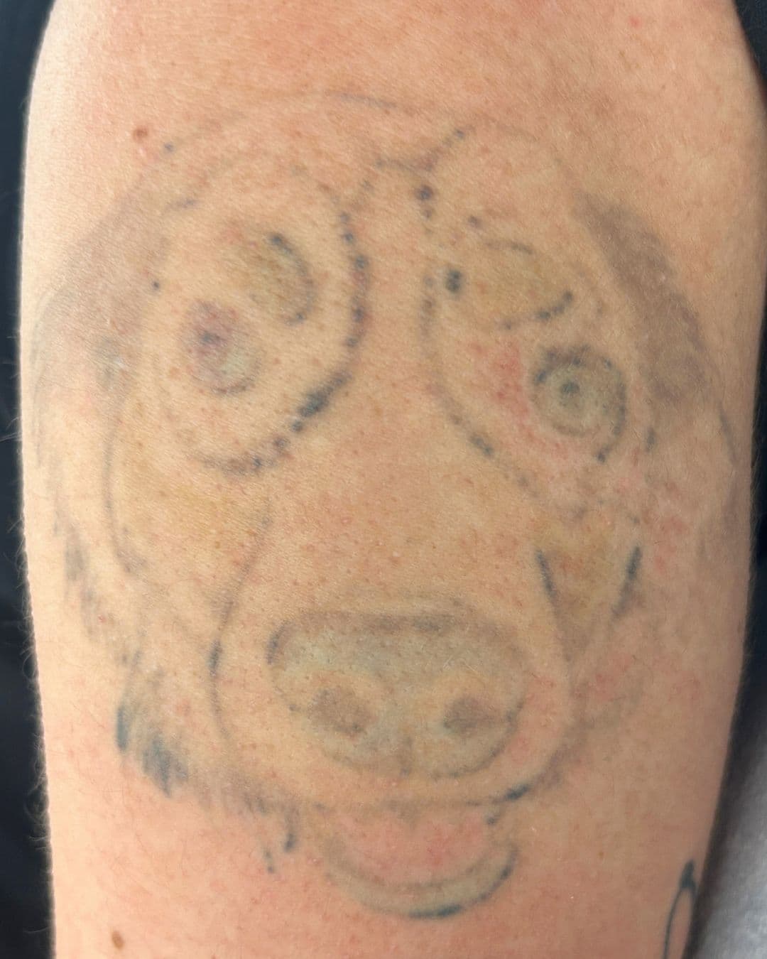 The same dog portrait tattoo after 10 laser removal sessions, heavily faded to soft outlines with healthy, undamaged skin