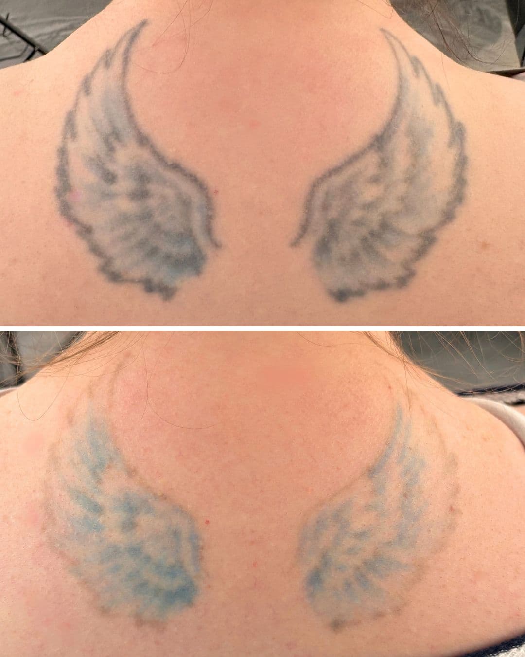 Before and after of a pair of angel wing tattoos on an upper back, the original heavily shaded in dark grey and black, and after three laser sessions most of the dark pigment has cleared leaving a soft blue in the feathers