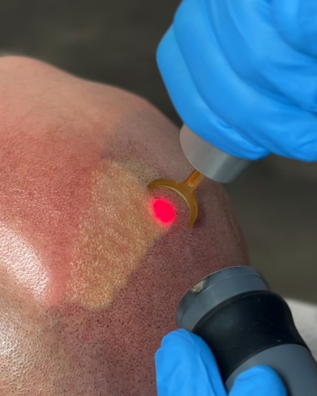 Studio Kiku technician guiding the PicoWay laser handpiece across a client's scalp during SMP pigment removal