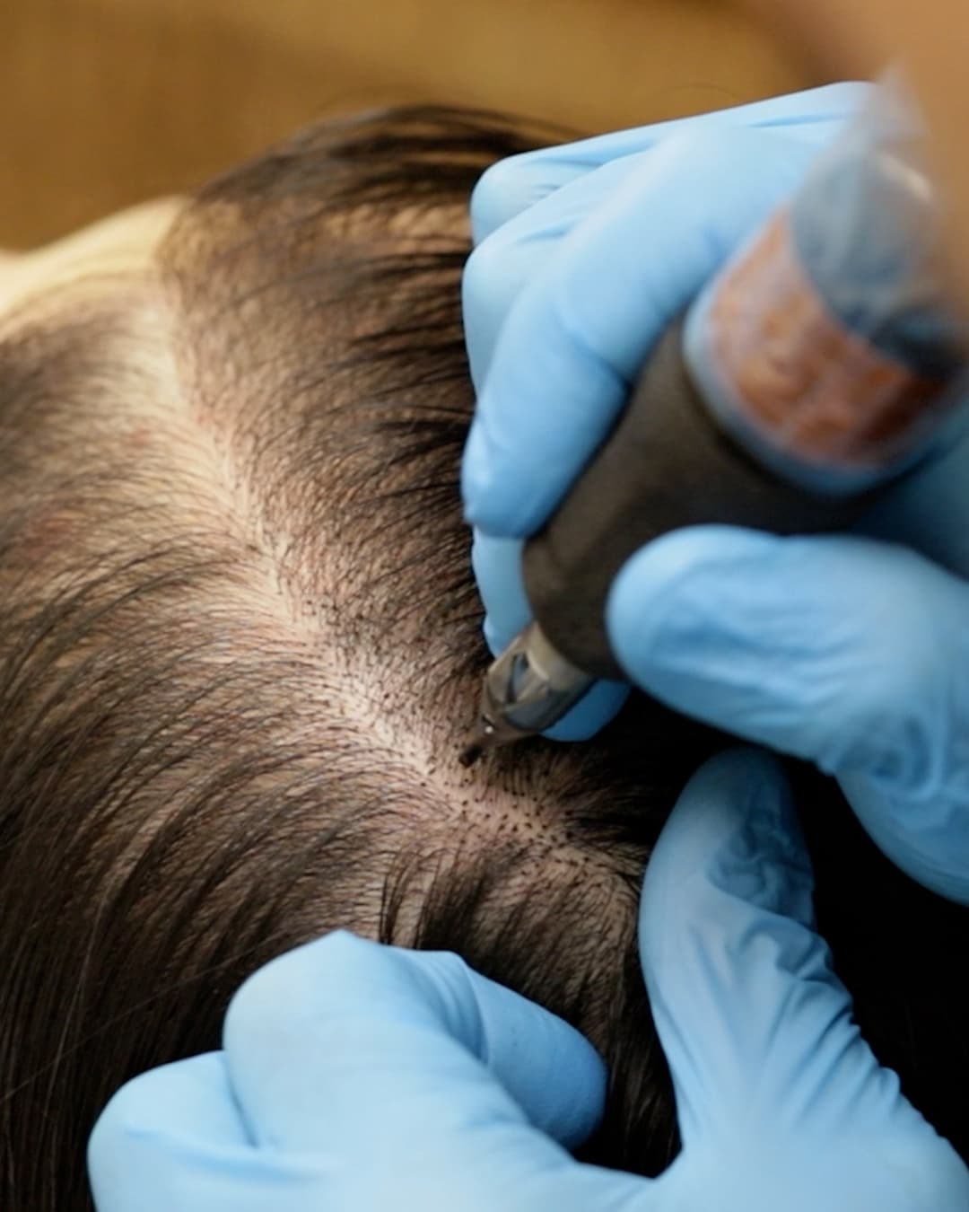 Studio Kiku technician applying scalp micropigmentation pigment dots to a client's crown where hair thinning is visible through the dark hair