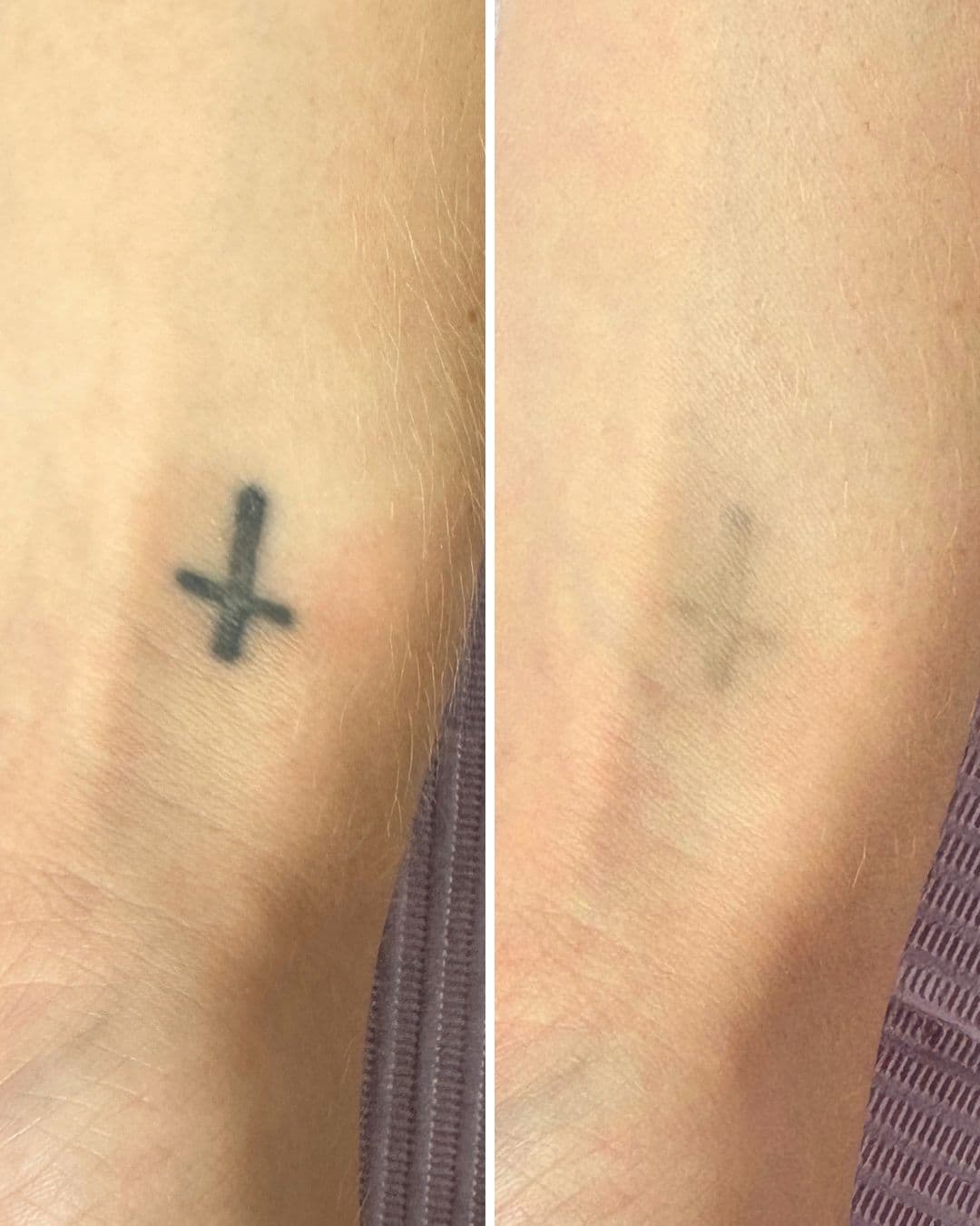 Side by side photos of a small black cross tattoo on a wrist, solid and sharp in the first image and faded to a soft grey smudge in the second after laser removal at Studio Kiku