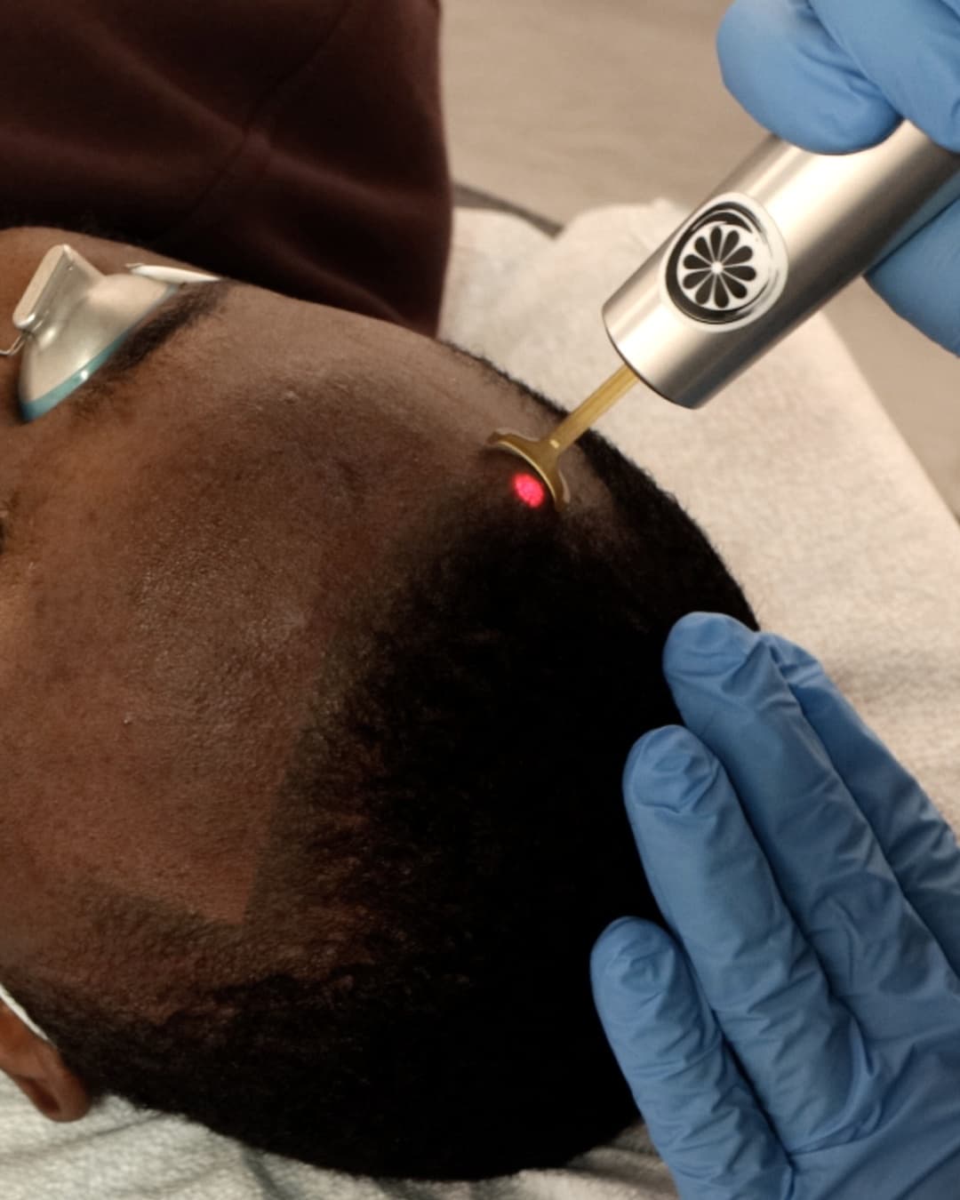 Studio Kiku technician applying the PicoWay laser handpiece to a client's scalp during an SMP removal treatment
