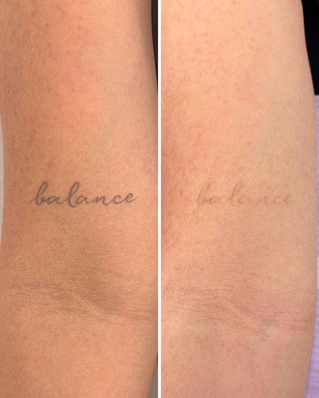 Before and after photos of a thin cursive word tattoo on an inner forearm, much lighter and patchy after laser removal at Studio Kiku