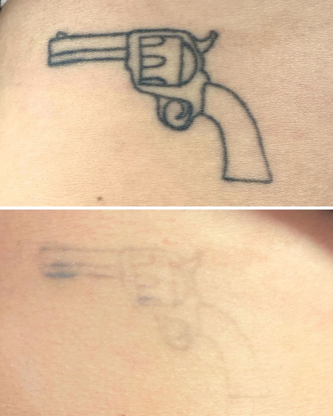 Before and after of a heavily saturated black revolver tattoo showing major fading after 6 laser removal sessions at Studio Kiku