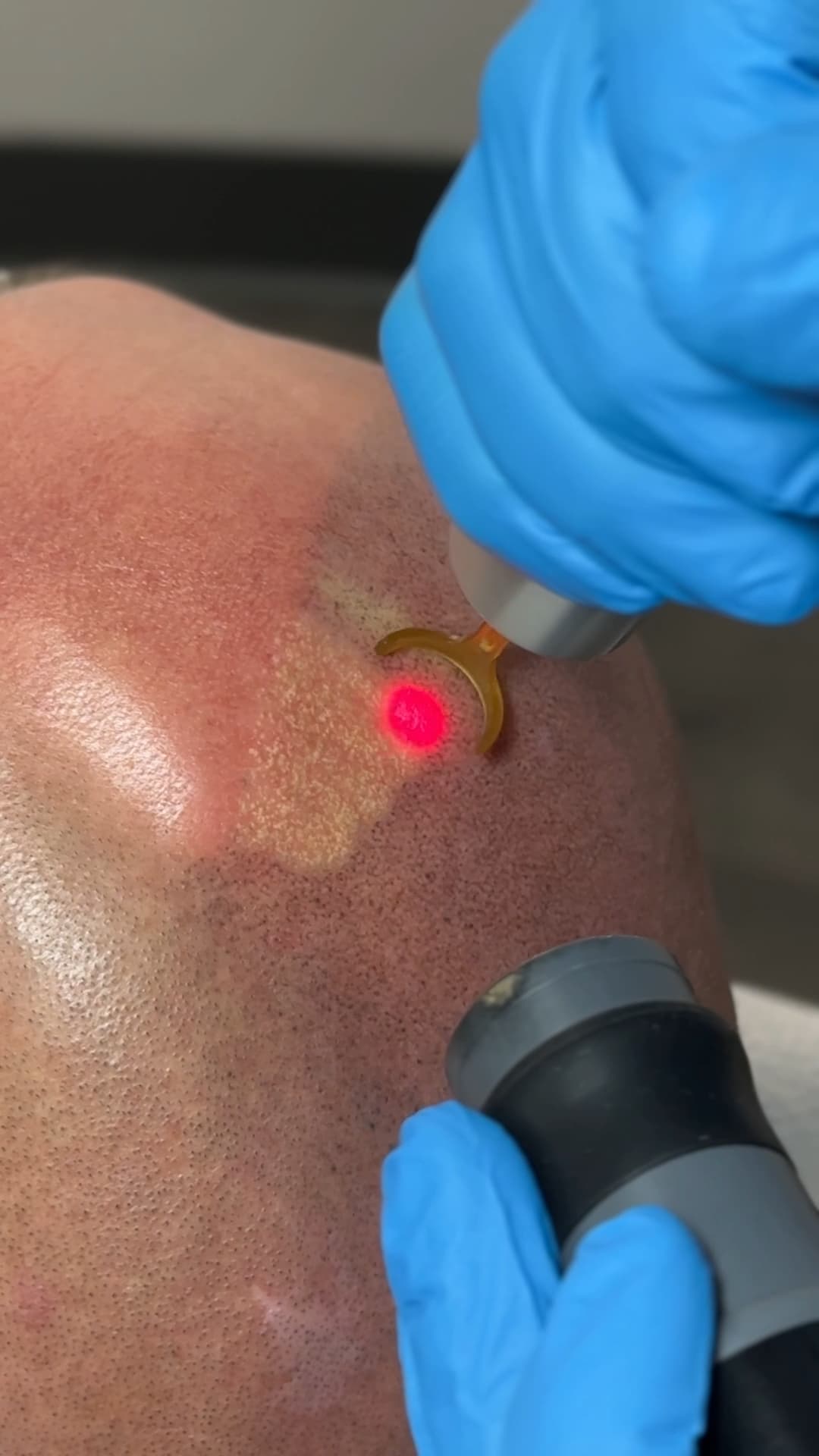 Gloved Studio Kiku technician holding the PicoWay handpiece against a client's scalp during SMP removal, with the red aiming beam visible on the pigmented area and a cooling air nozzle held below it