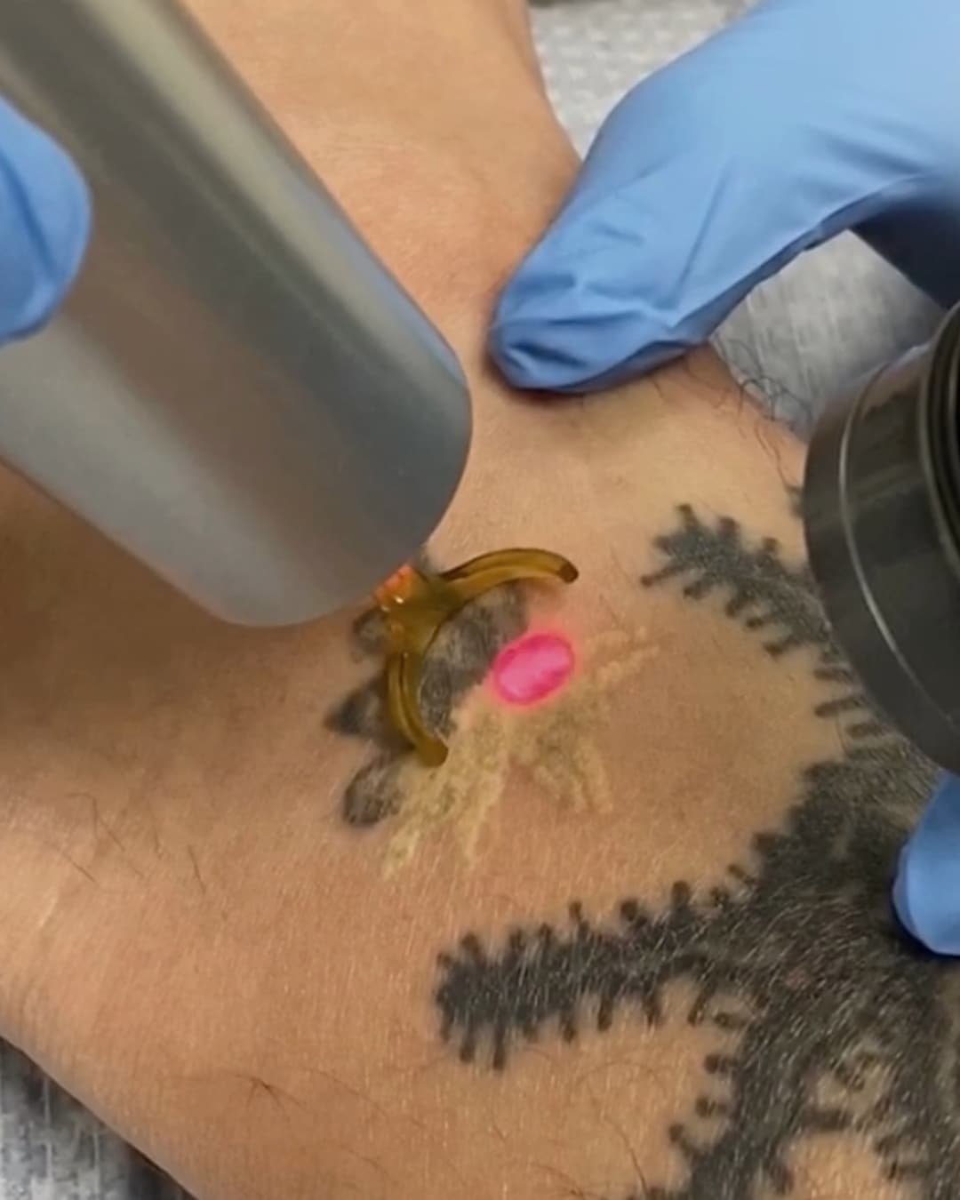 Studio Kiku technician positioning a PicoWay laser handpiece over a dark botanical tattoo on a client's forearm during a removal session