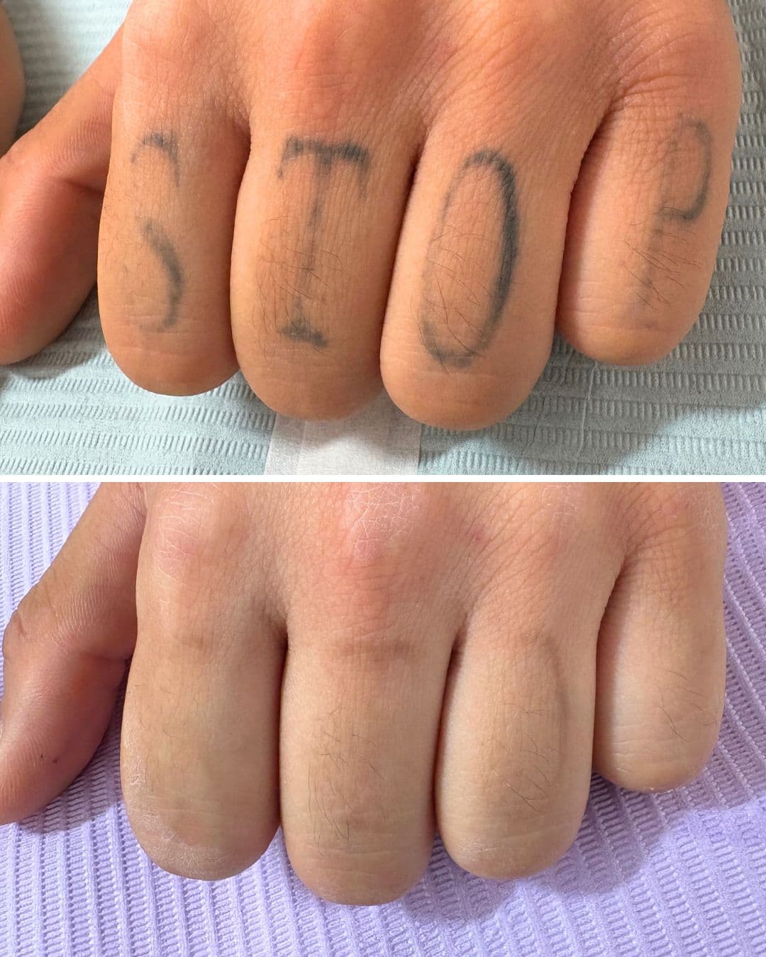 Before-and-after comparison of blown-out knuckle tattoos spelling STOP, showing significant fading after five laser sessions at Studio Kiku with no skin damage