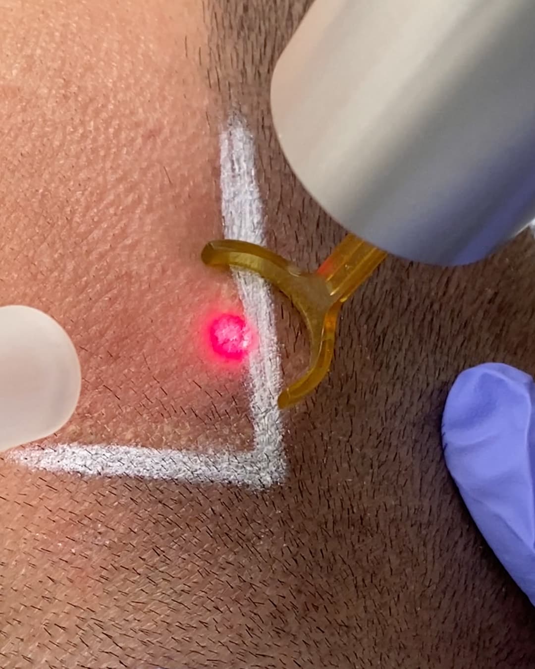 Studio Kiku technician treating a precisely marked scalp hairline with the PicoWay laser during an SMP hairline correction session