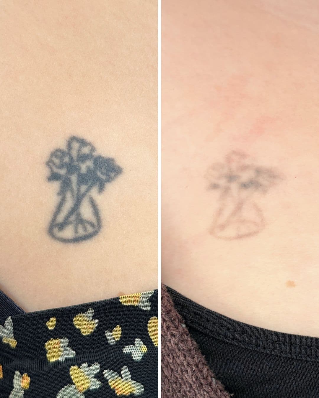 Side-by-side photo of a small black flower-and-vase tattoo on the upper chest, with the right side showing it faded to a soft, faint outline after four laser sessions