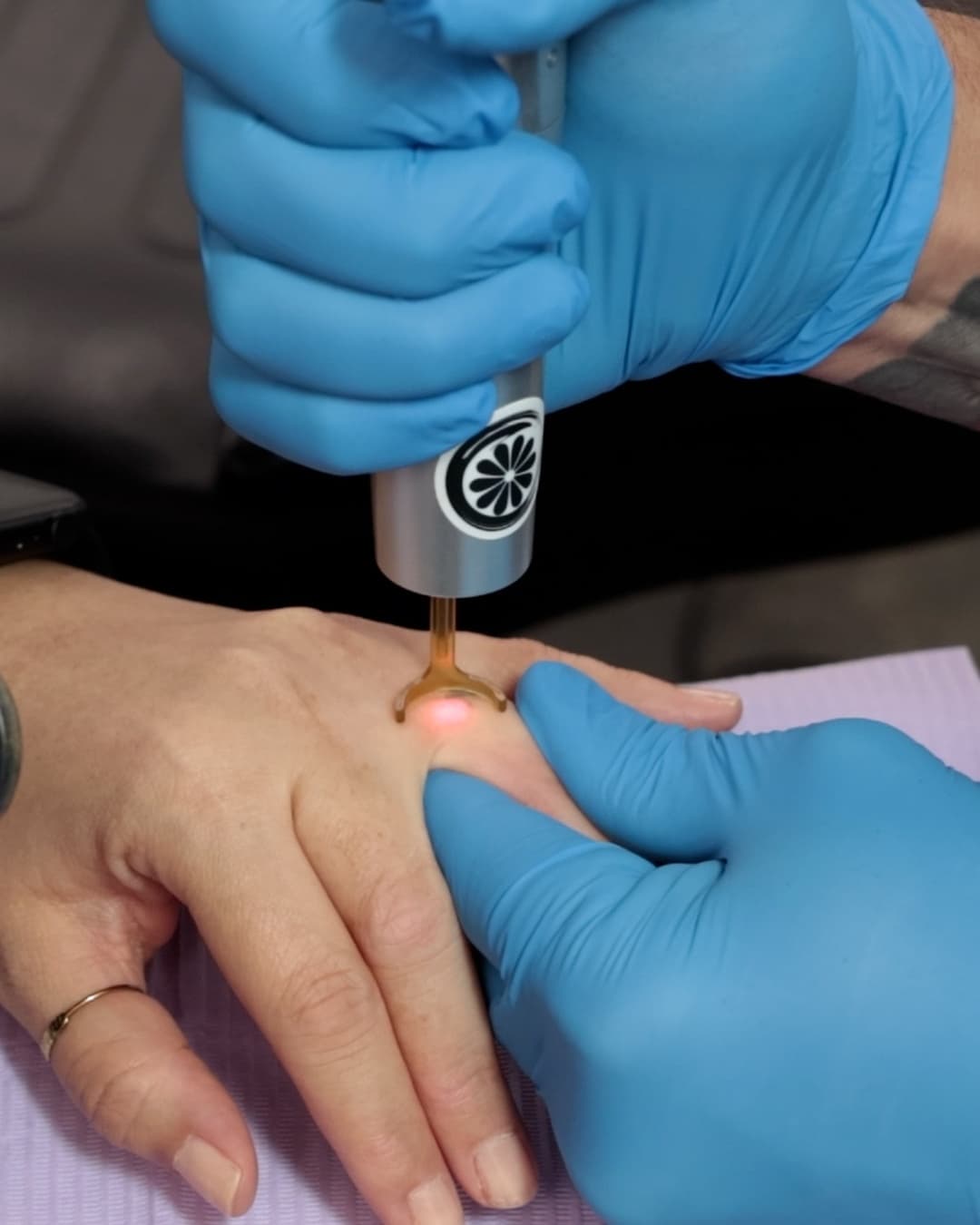 Studio Kiku technician applying the PicoWay laser handpiece to a client's hand during a laser tattoo removal session