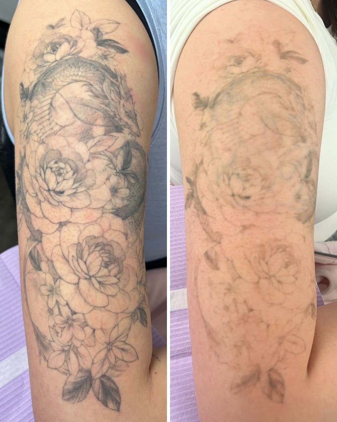 Before and after photos of a black and grey upper arm tattoo of peonies, blossoms and a dragon, shown untreated on the left and after two PicoWay laser sessions on the right, where the shading has faded to a faint trace
