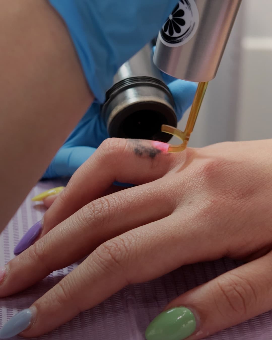 Studio Kiku technician in blue gloves treating a small finger tattoo with the PicoWay laser handpiece during a removal session