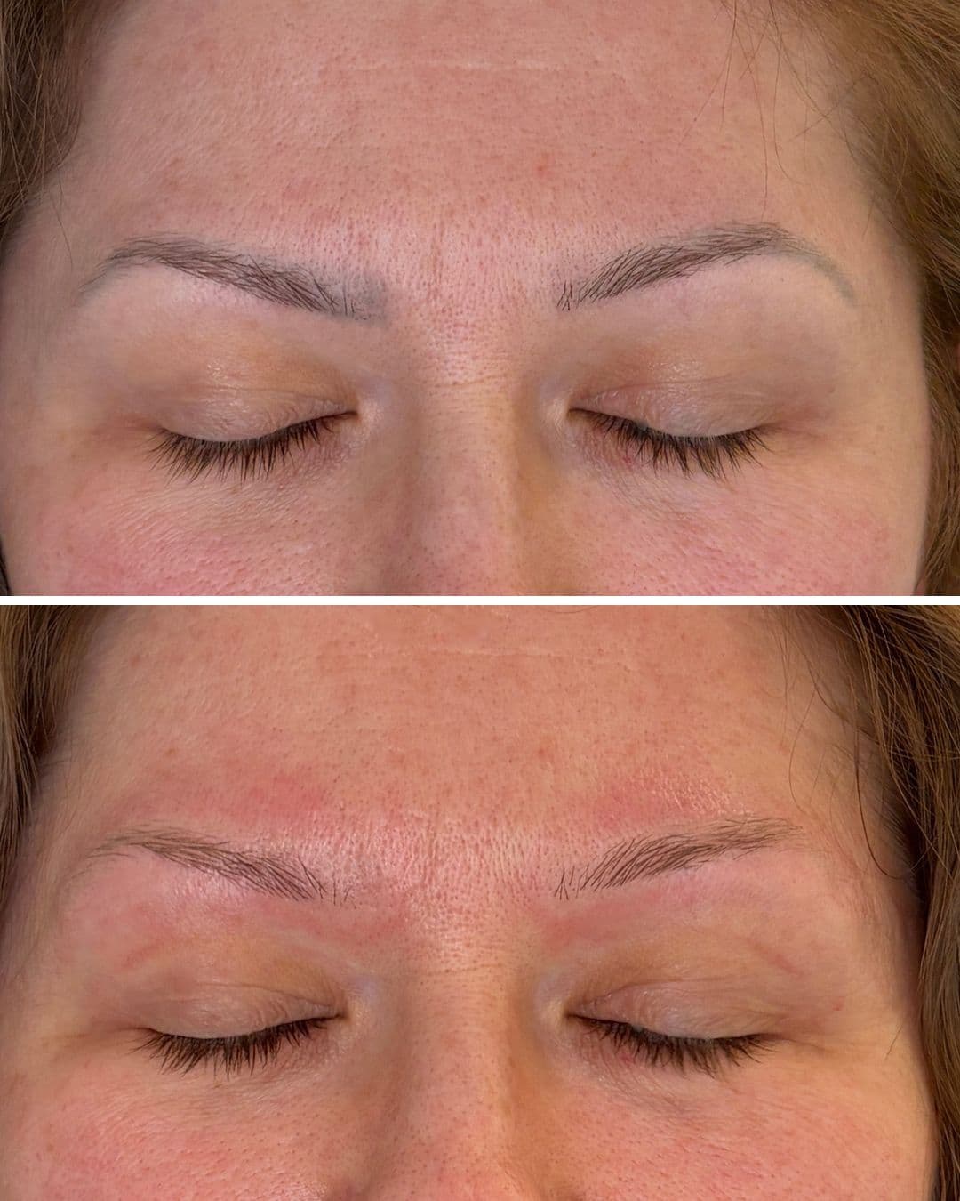 Before and after of laser PMU brow removal: thin grey brow pigment above closed eyes, then the same brows straight after a PicoWay session with the pigment lifted, the natural hairs still in place and the skin flushed pink