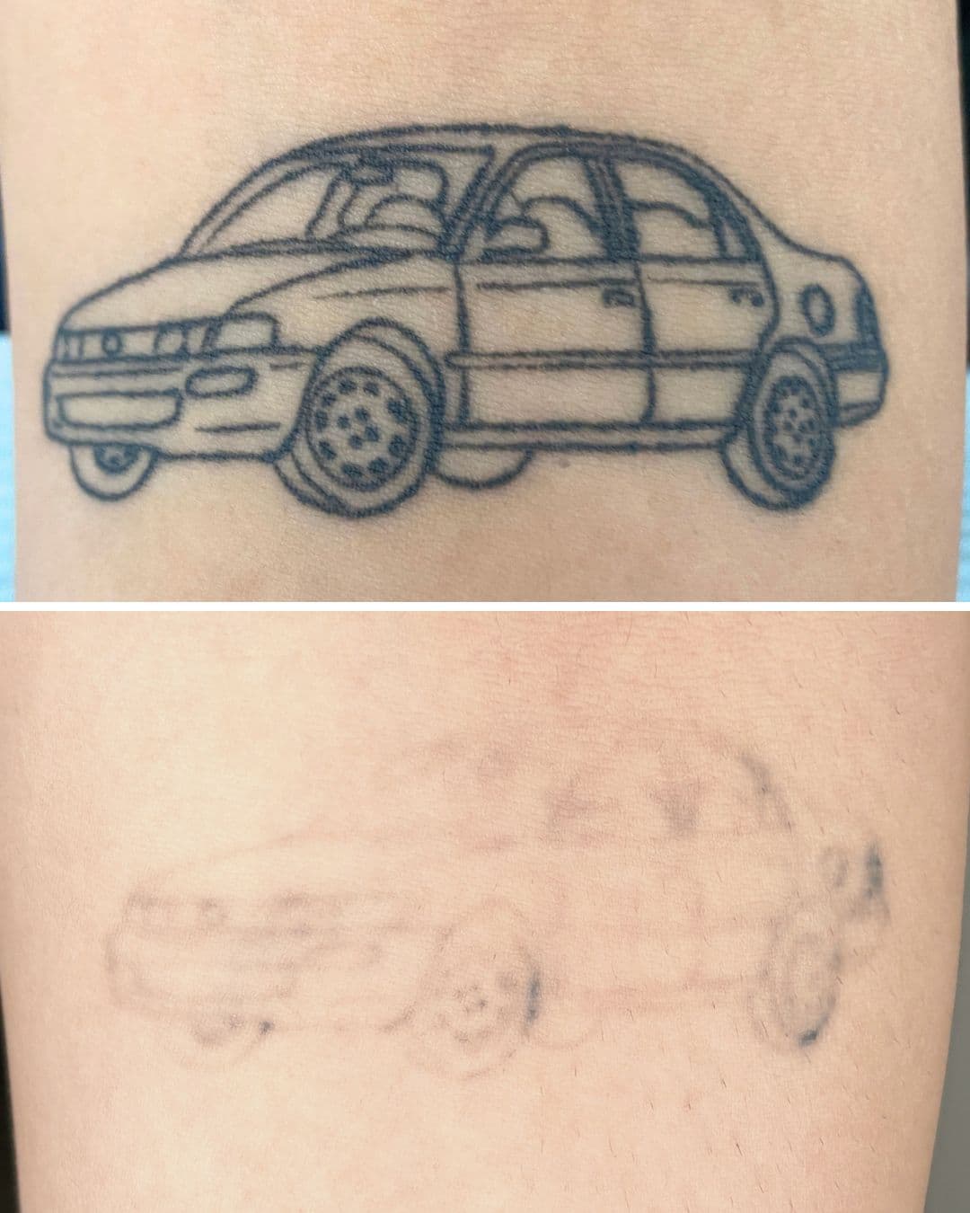 Before-and-after of a detailed car line-work tattoo: dark and crisp before treatment, nearly invisible after seven sessions of laser tattoo removal.