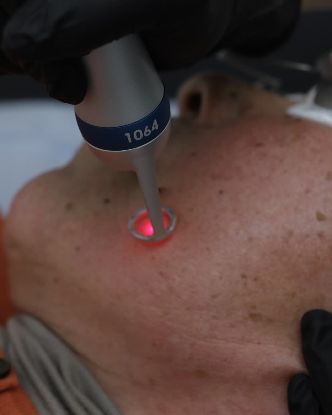 Studio Kiku technician in dark gloves holding the PicoWay 1064nm laser handpiece against a client's freckled skin during a laser treatment session