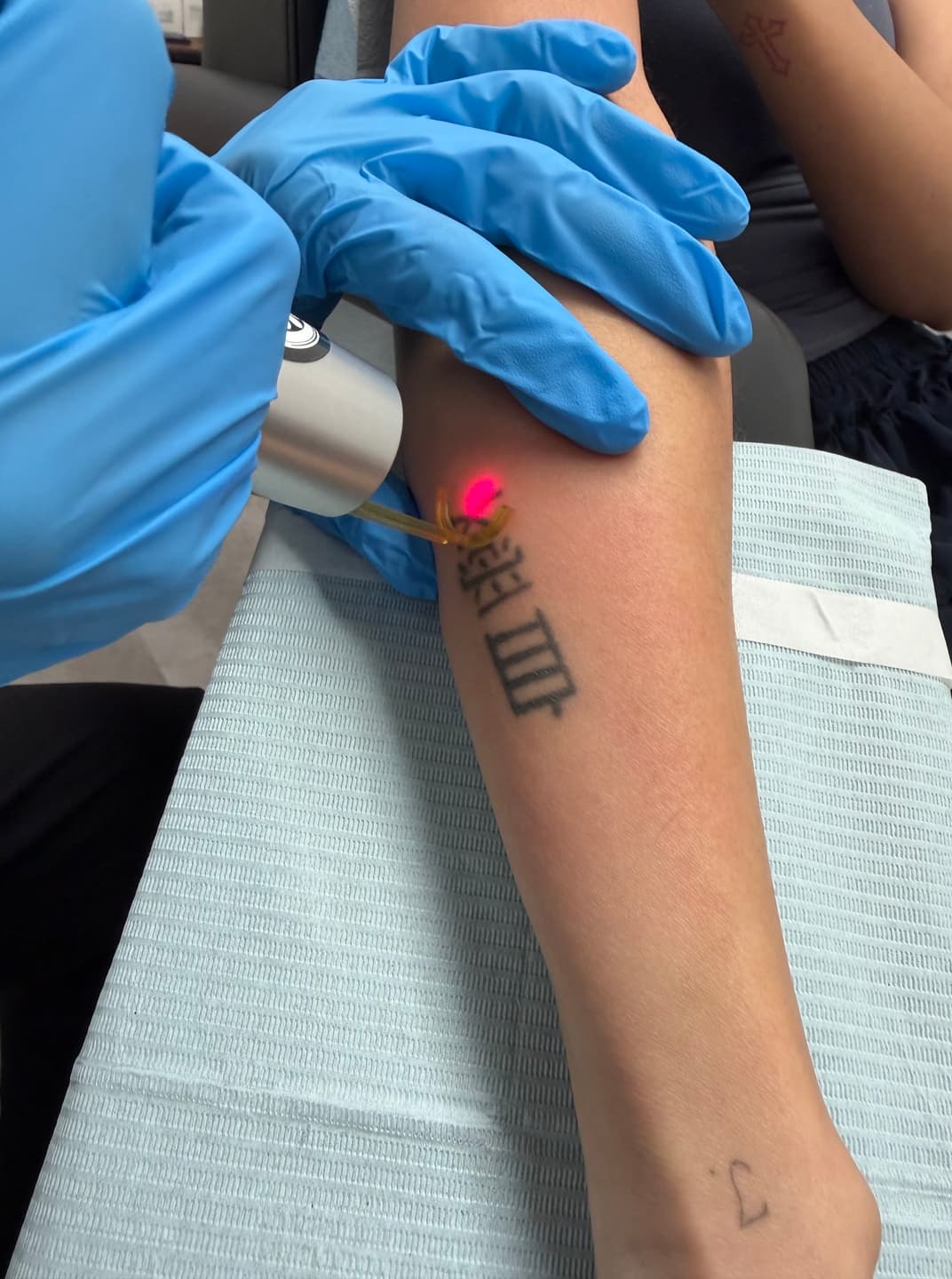 Studio Kiku laser technician applying the PicoWay handpiece to a forearm tattoo during a removal session at the Vaughan location
