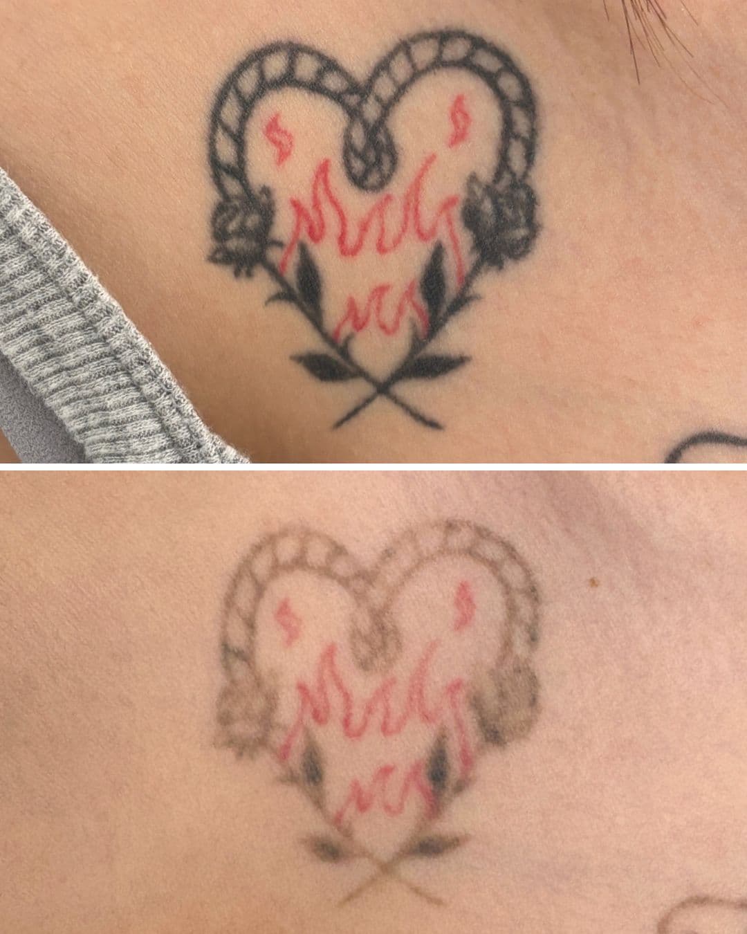 Before-and-after comparison of a heart-shaped tattoo with script and roses on skin, showing visible fading after six laser removal sessions at Studio Kiku