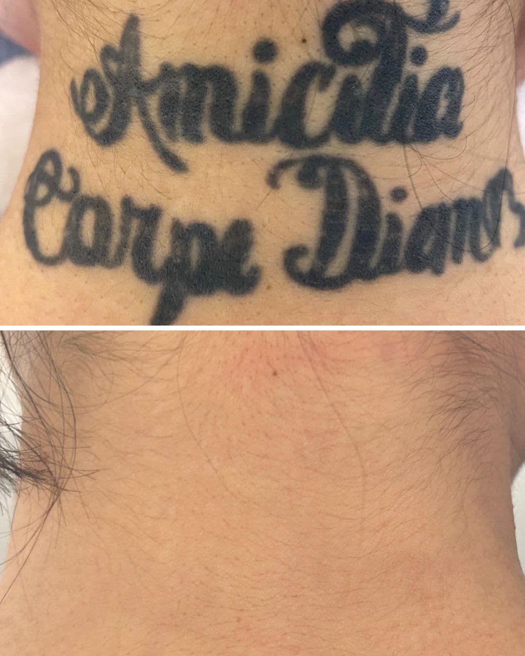 Before and after of a script neck tattoo reading Amicitia Carpe Diem, the lower image showing clear skin after laser removal at Studio Kiku.