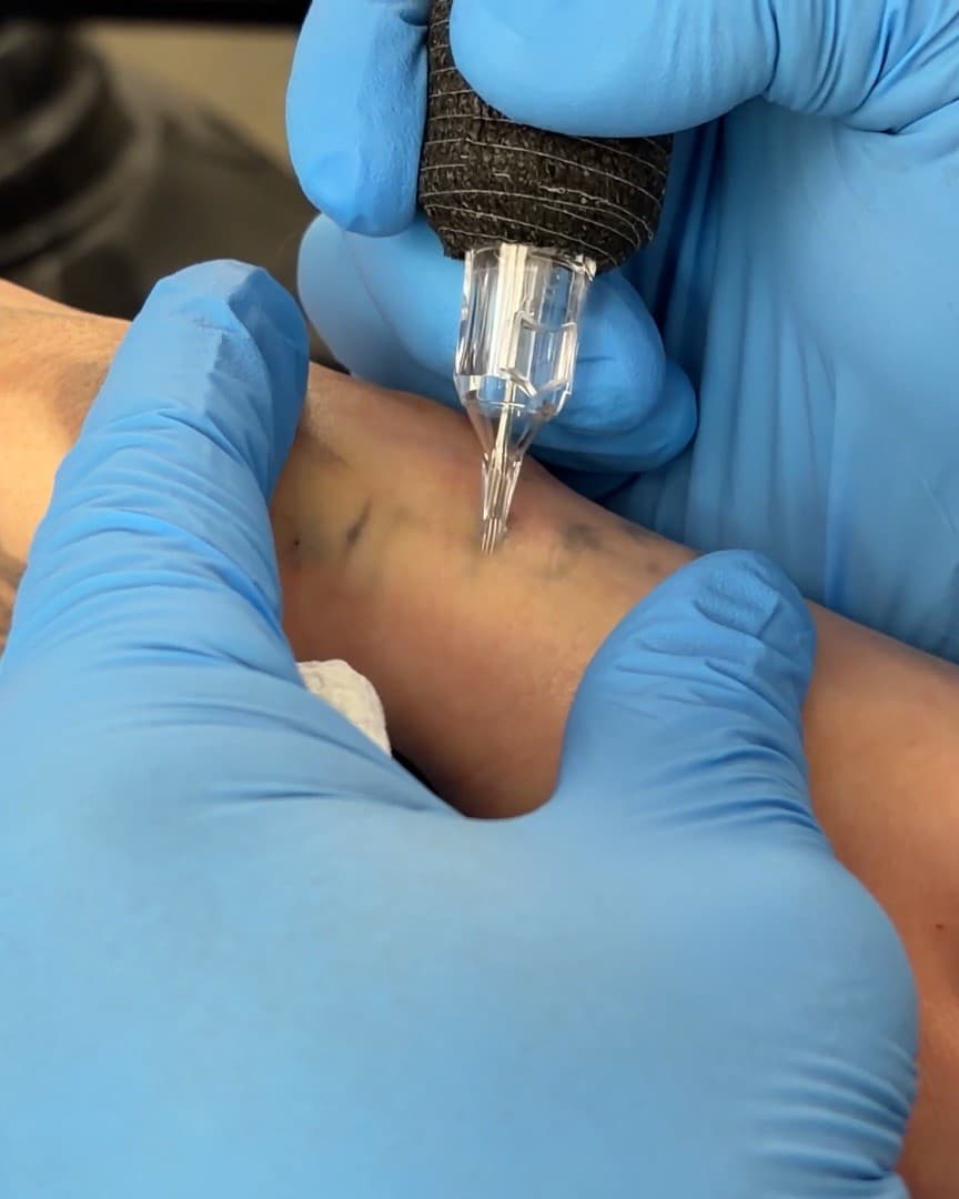 Saline tattoo removal in progress at Studio Kiku