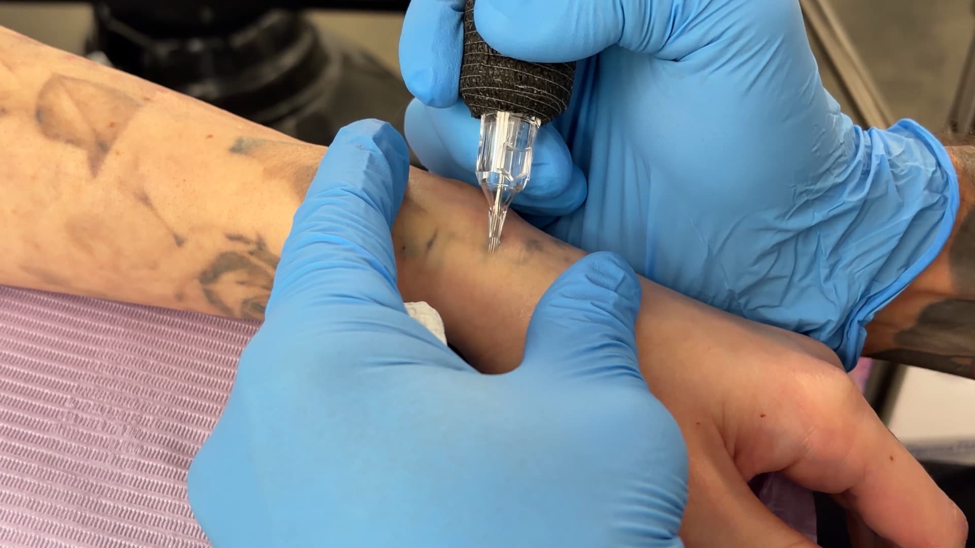 Saline tattoo removal in progress at Studio Kiku