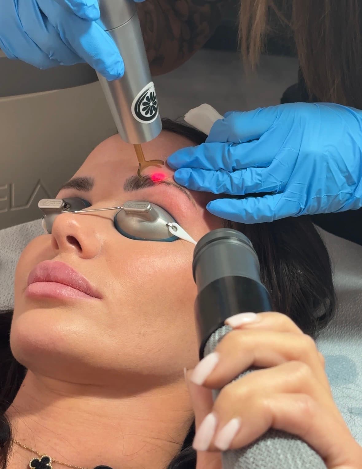 Laser PMU removal session in progress at Studio Kiku