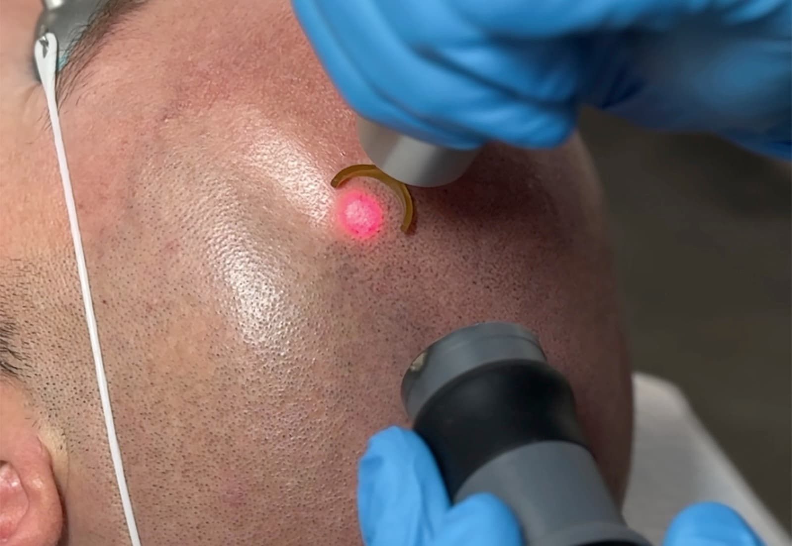 Scalp micropigmentation removal at Studio Kiku