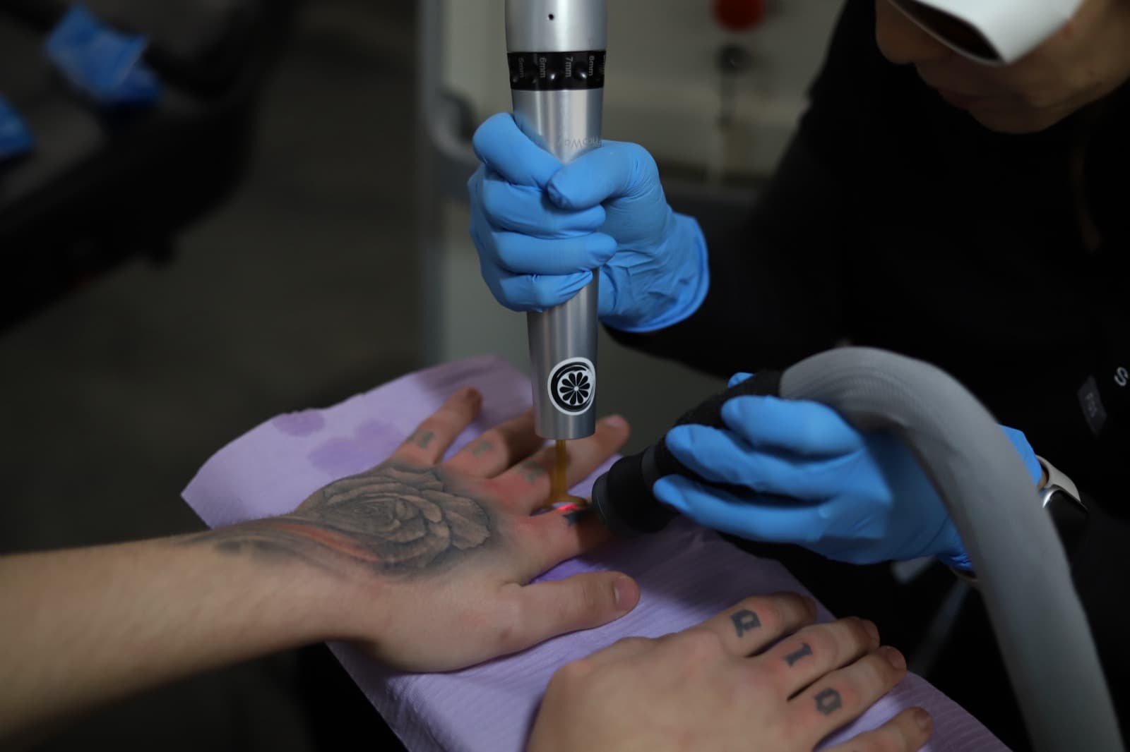 Laser tattoo removal on a hand at Studio Kiku