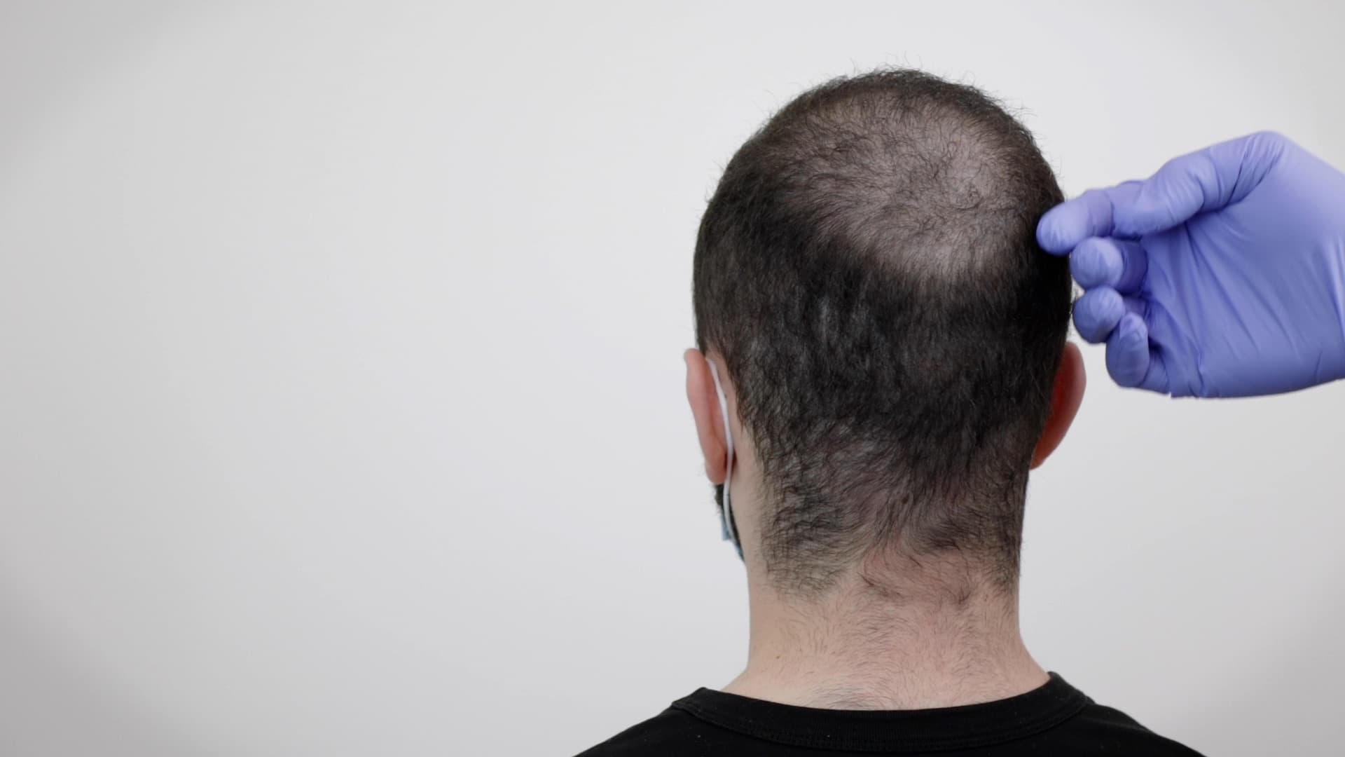 Studio Kiku SMP demonstration: FUE Scar Concealment