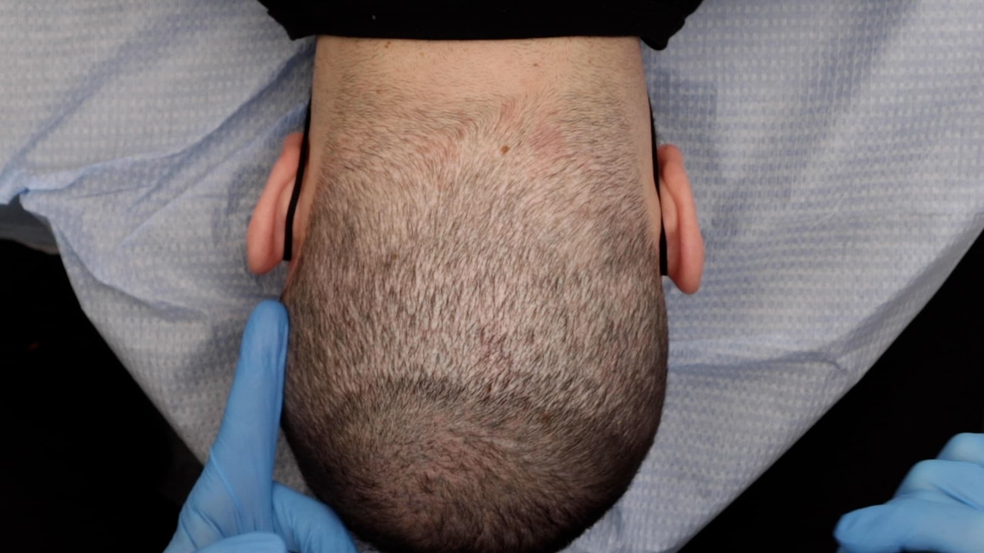 Scalp micropigmentation concealing a hair transplant scar