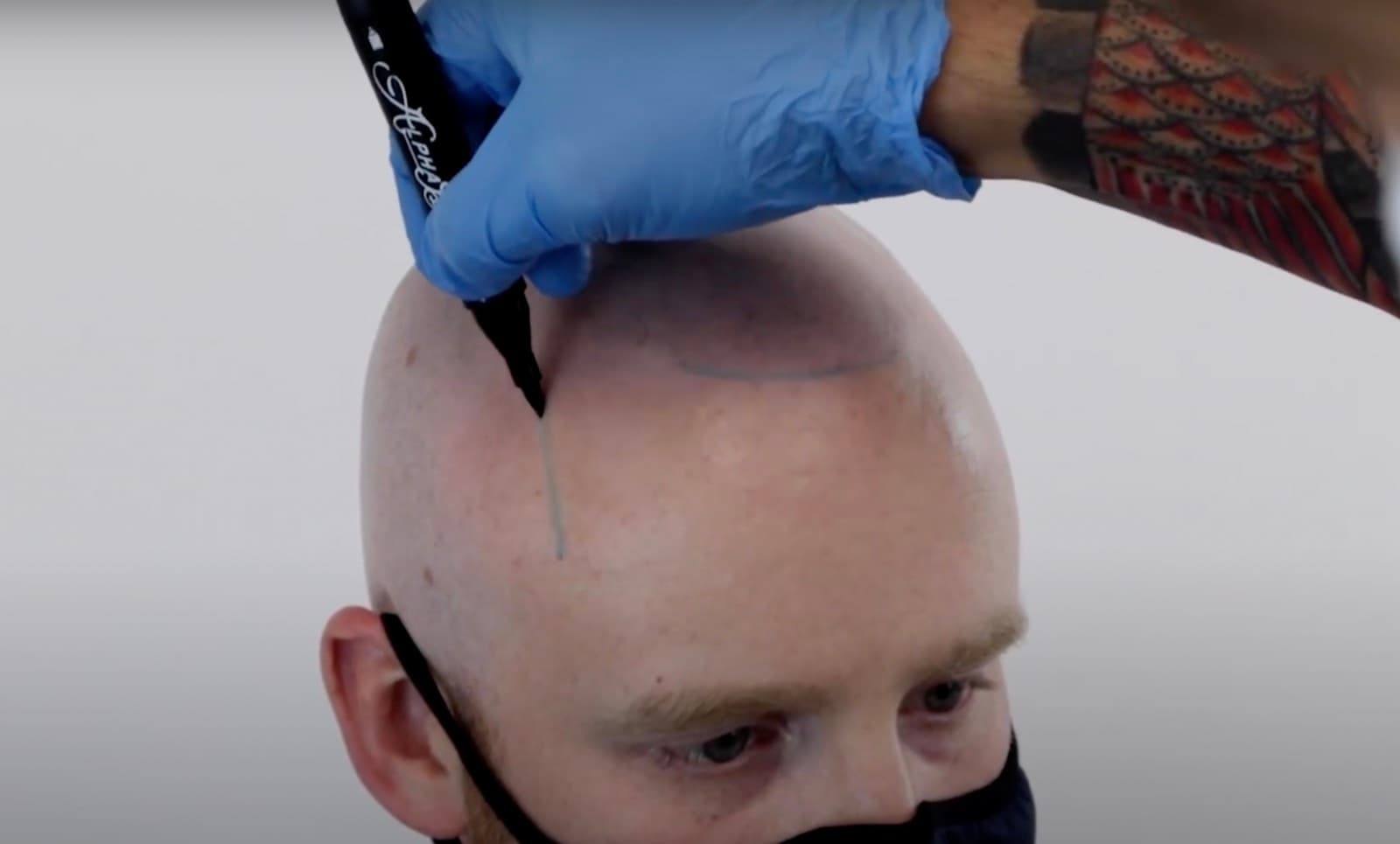 A natural SMP hairline being drawn on a client before the procedure begins