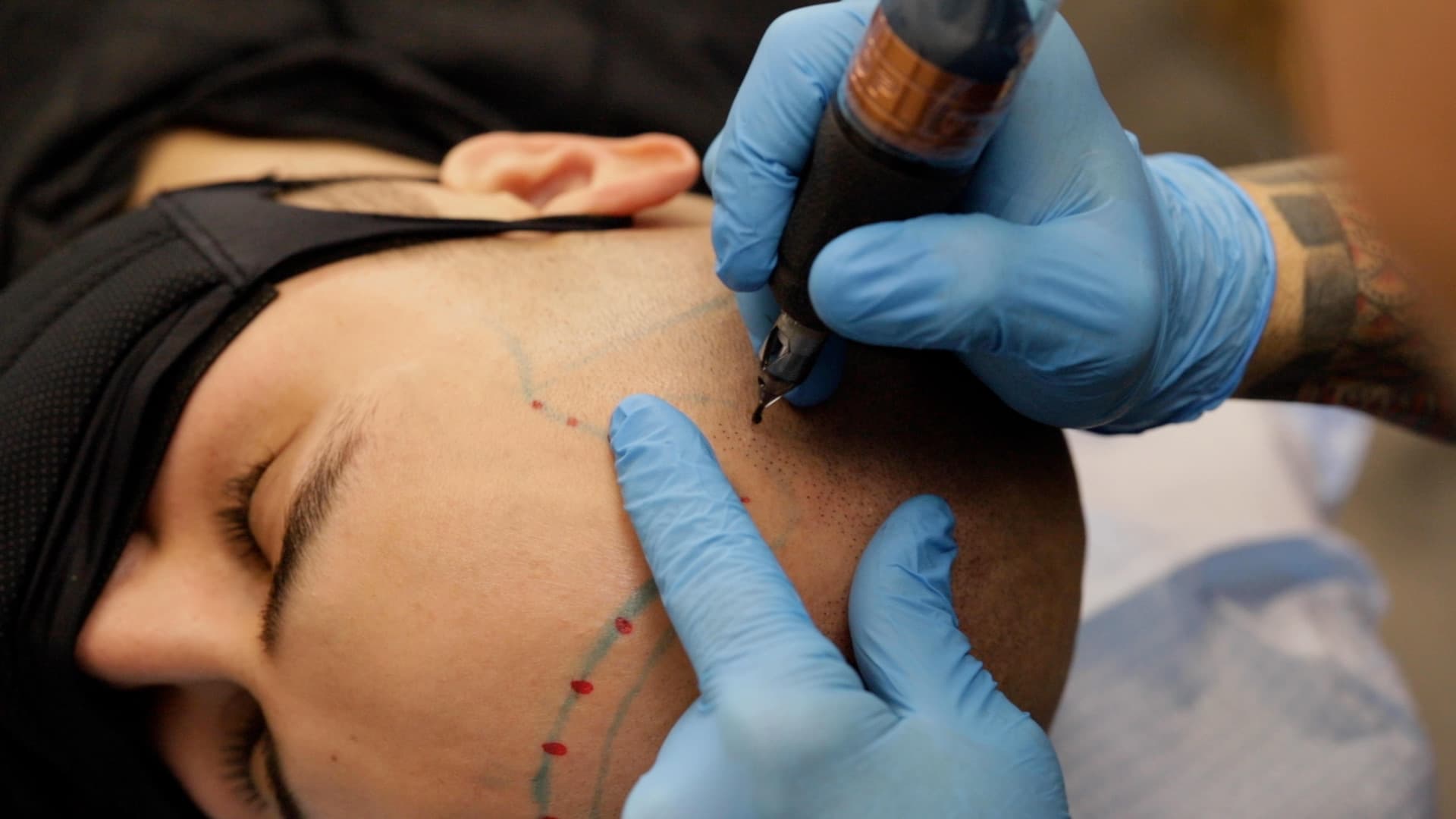Scalp micropigmentation for alopecia hair loss