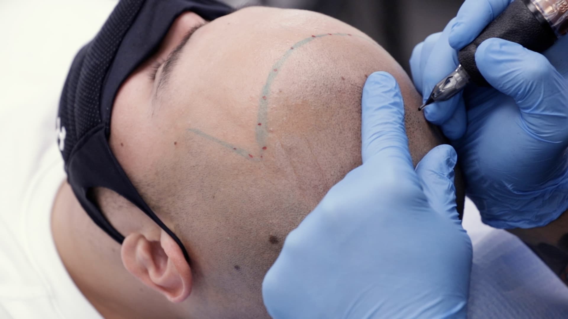 Scalp micropigmentation for male pattern baldness