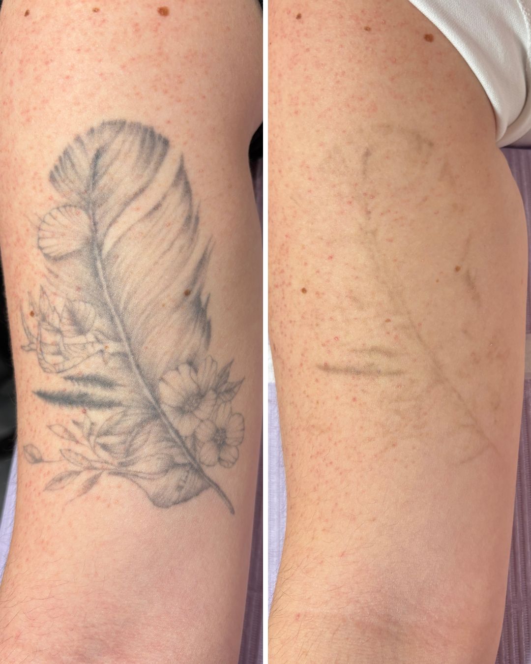 Tattoo removal result — 3 sessions