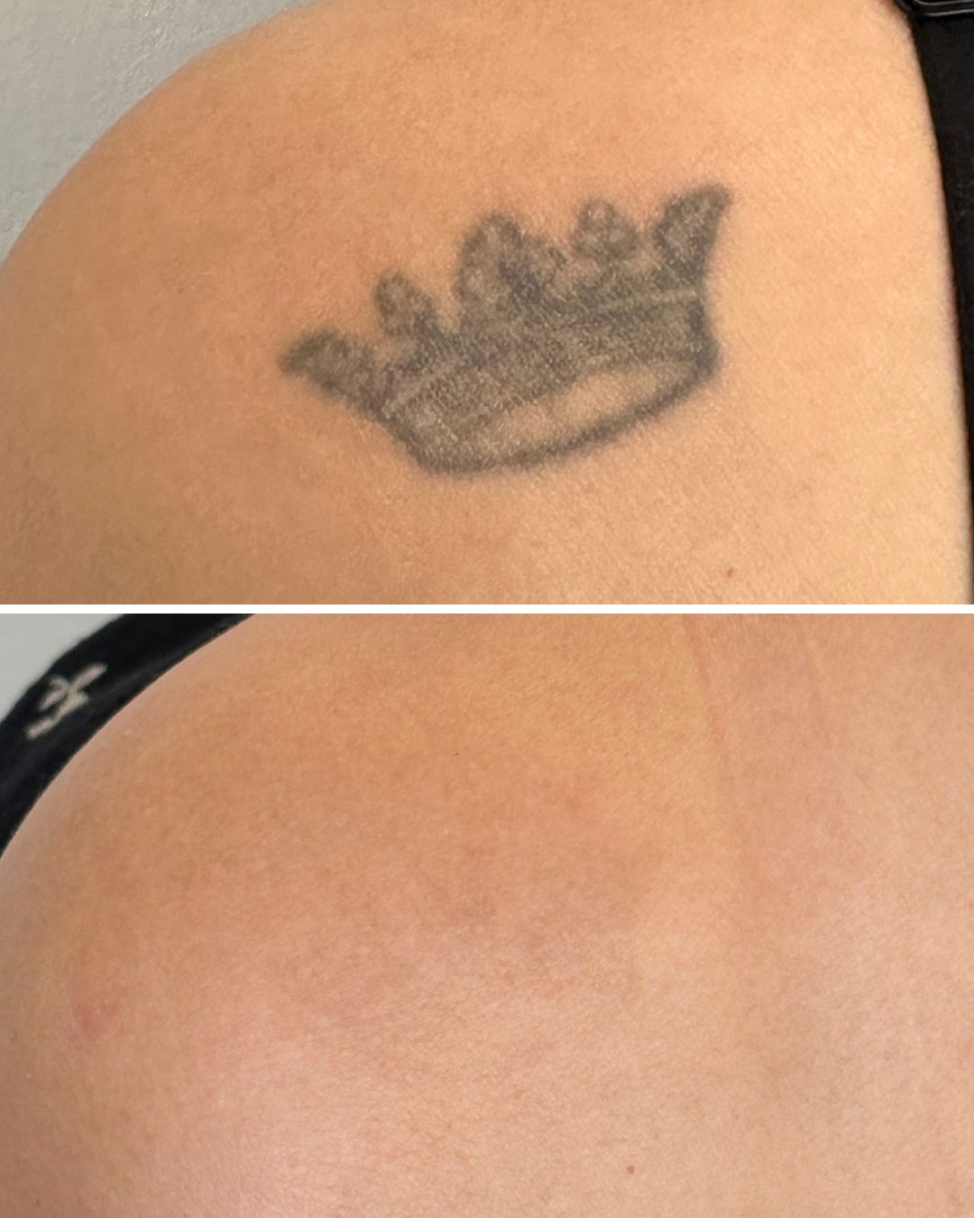 Tattoo removal result — 5 sessions