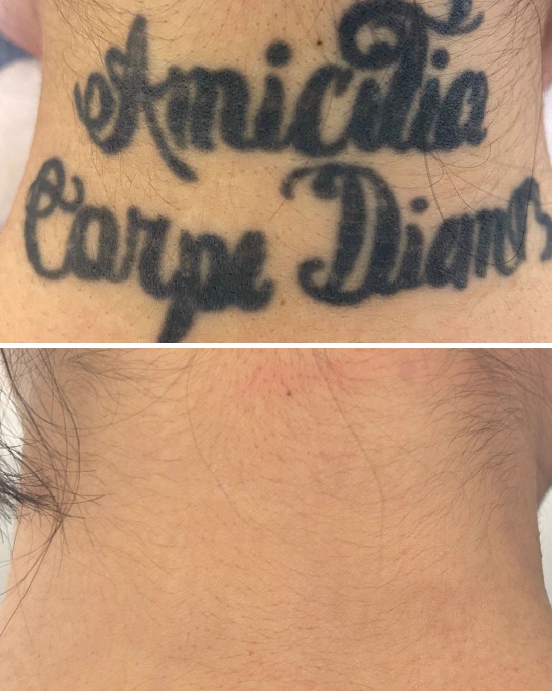 Tattoo removal result — 7 sessions