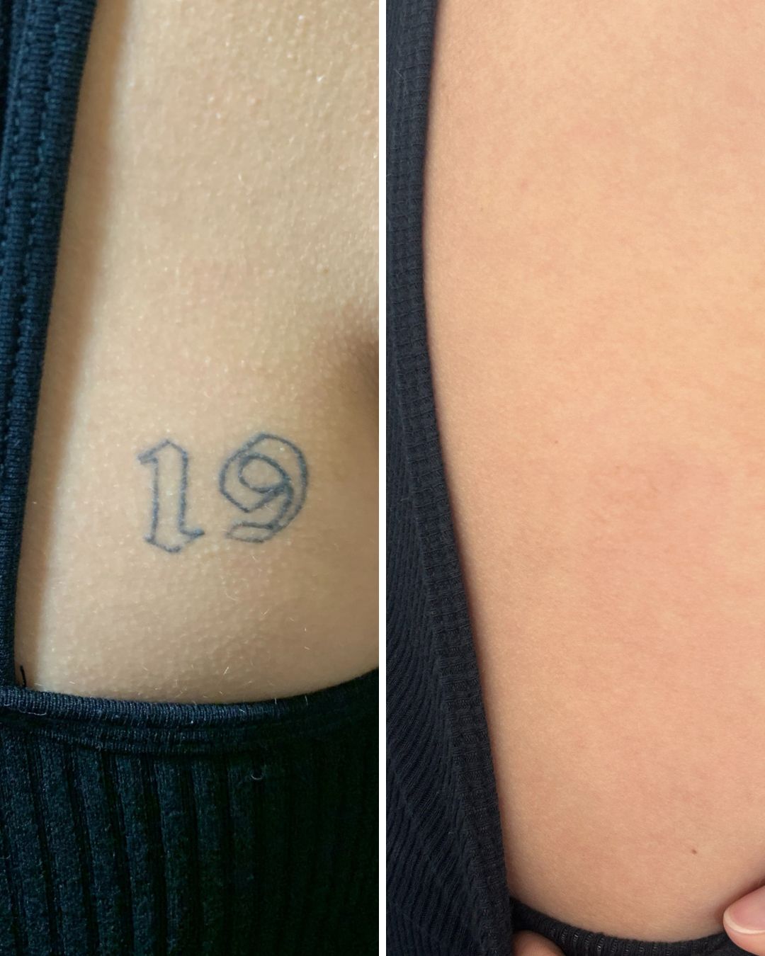 Tattoo removal result — 9 sessions