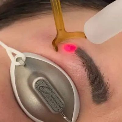 Laser PMU removal at Studio Kiku