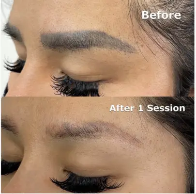Covering brows with makeup during the PMU removal process is possible.