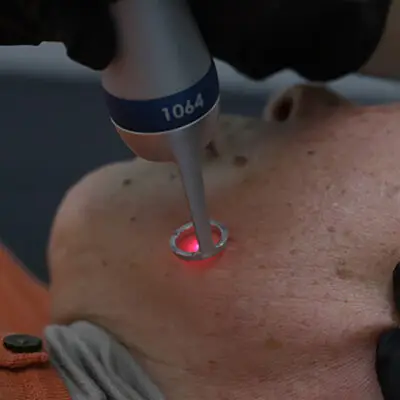 Pico Laser Facial