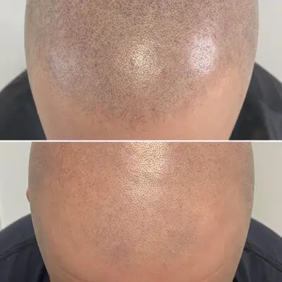 Scalp Micropigmentaion (SMP) Removal with the PicoWay is safe and highly effective.