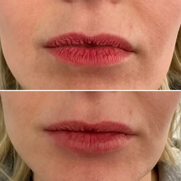 Lip blush removal before and after photos
