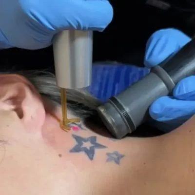 Laser Tattoo Removal
