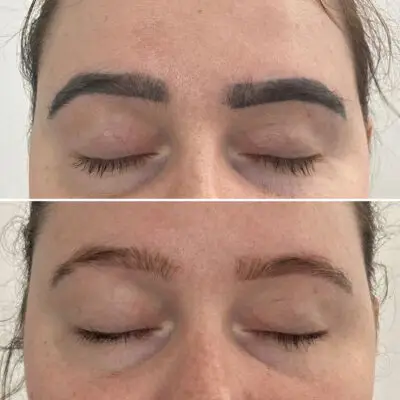 brow-removal