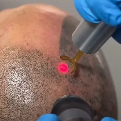 Adjust the SMP Hairline with the PicoWay Laser